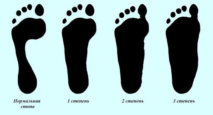 vlakke voeten 3 graden behandeling