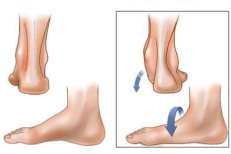 Este posibilă vindecarea picioarelor plate de 3 grade