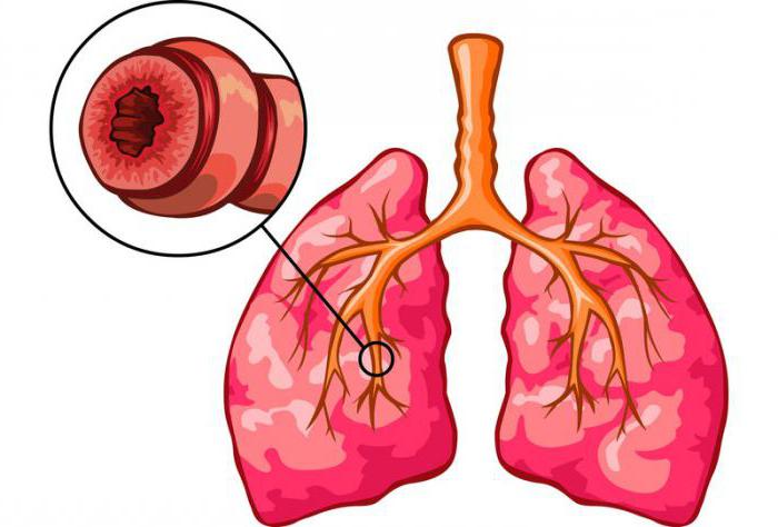 zda se vezmou do armády s bronchiálním astmatem